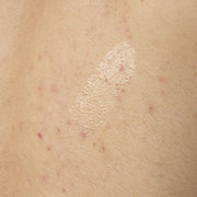 Close-up texture shot of Salicylic Acid 0.5% Body Serum. The clear, lightweight gel is shown applied directly to skin with some visible body acne, demonstrating its consistency.